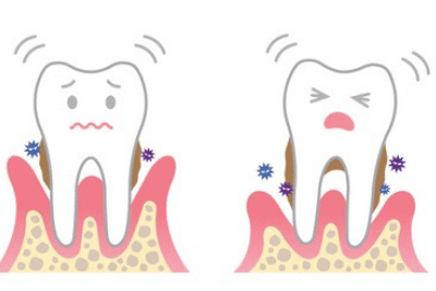 mobile tooth