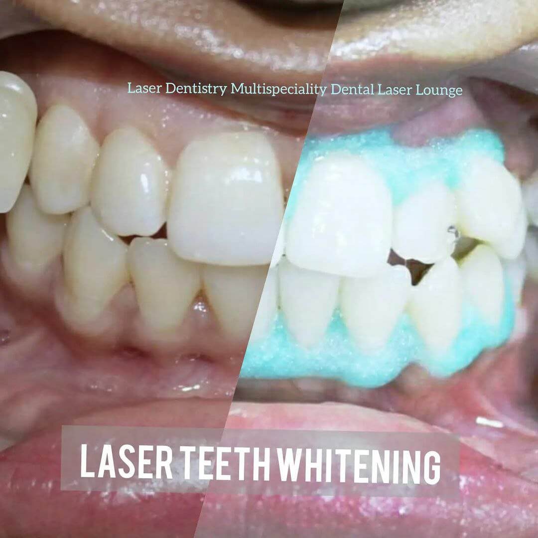 laser teeth whitening